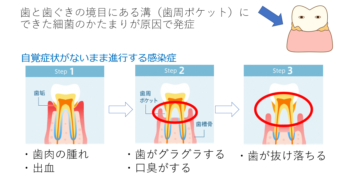 歯周病